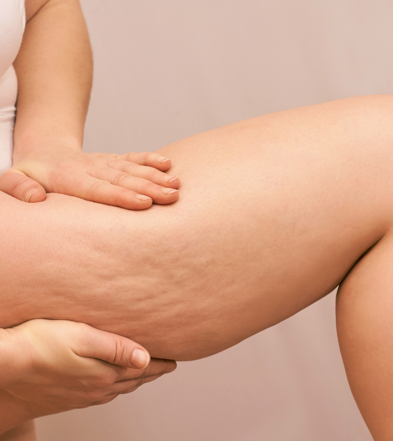Traitement Anti-Cellulite