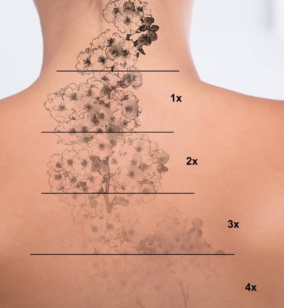 comment est la peau apres une seance de detatouage