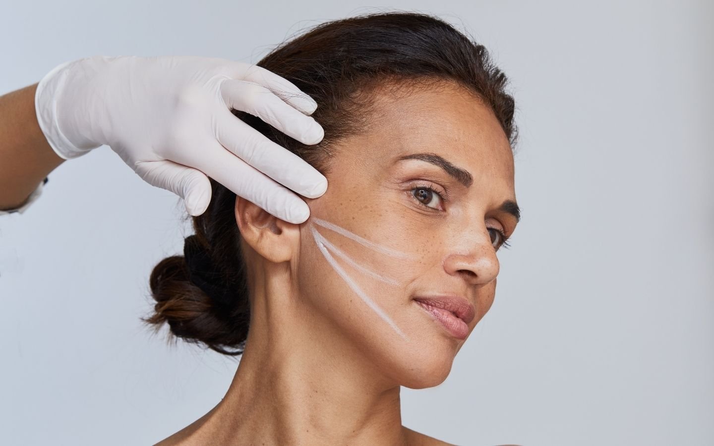 fils tenseurs resorbables femme