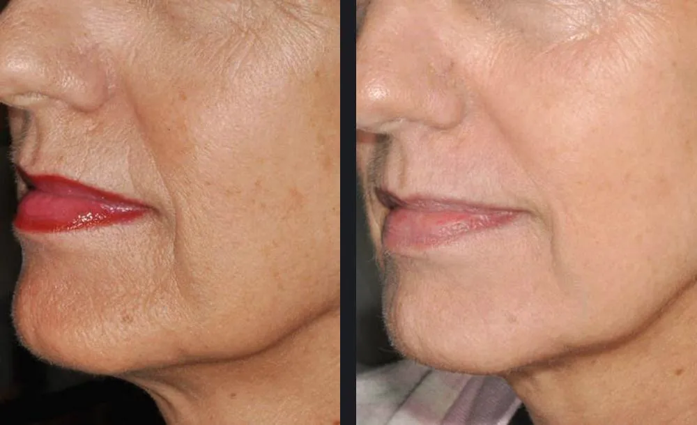 nordlys skin rejuvenation sebastian cintolesi md p1.jpg