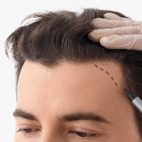 Greffe de cheveux valenciennes